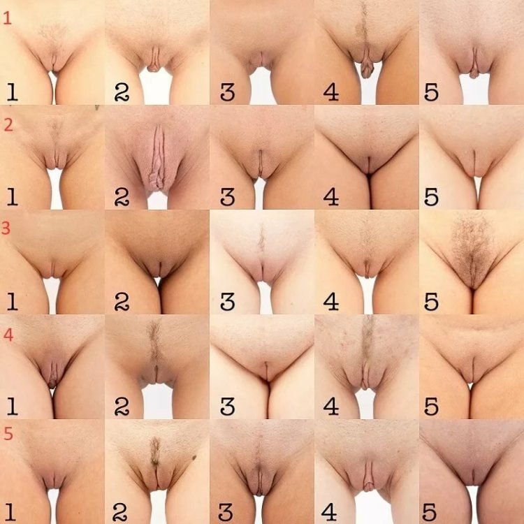 Vaginal plastic (vaginoplasty)