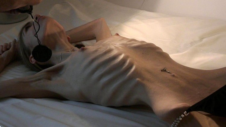 Genitalia of anorexics