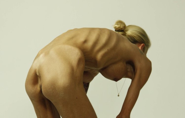 Riley Reed and people with anorexia